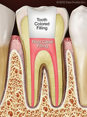 Root Canal Specialist Washington DC