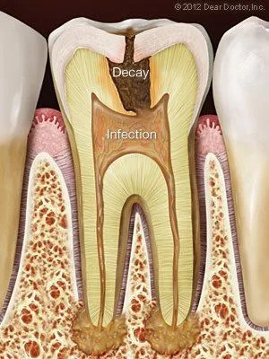 Root Canal Treatment Washington DC
